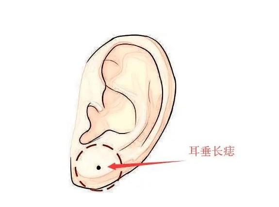 三处有痣菩萨转世(具体是哪三处)